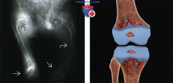 Кости при гипофосфатазии - лучевая диагностика