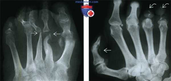 Кости при лепре - лучевая диагностика