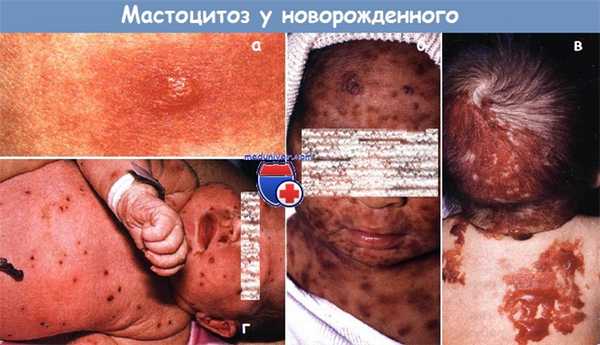 Мастоцитоз у новорожденного