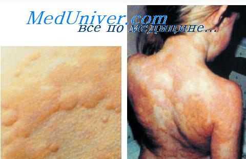 мастоцитоз