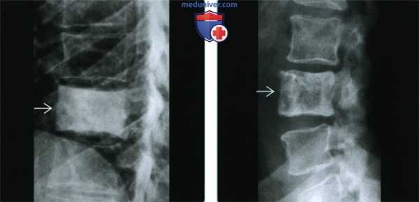 Кости при мастоцитозе - лучевая диагностика