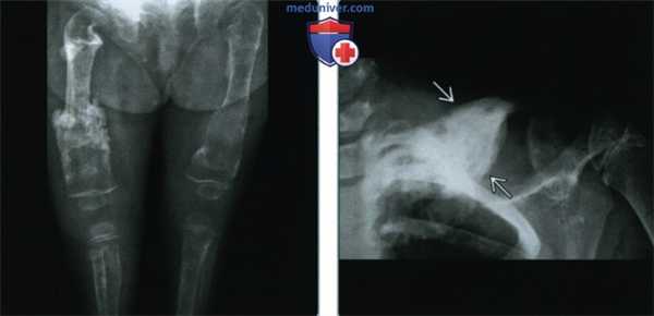 Кости при мастоцитозе - лучевая диагностика