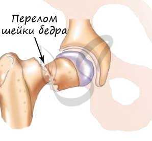 Перелом шейки бедра