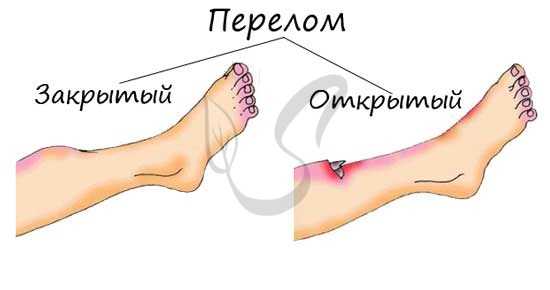 Открытые и закрытые переломы