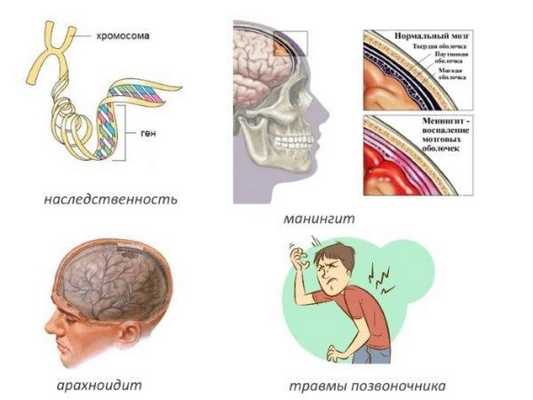 Частые причины сирингомиелии