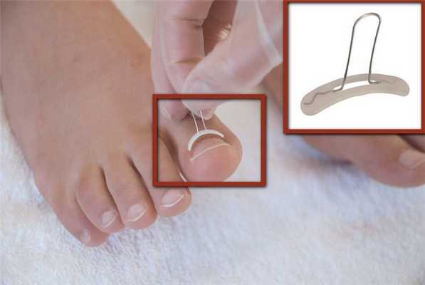 Коррекционная система для ногтя