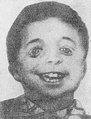 Рис. 3. Ребенок с челюстно-лицевым дизостозом. Характерны широкие косо расположенные глазные щели, нарушение развития зубов.