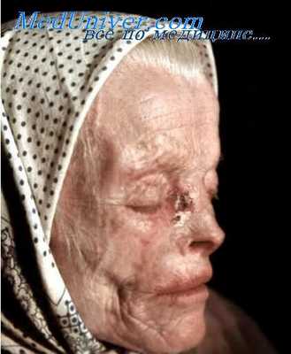 дискератома