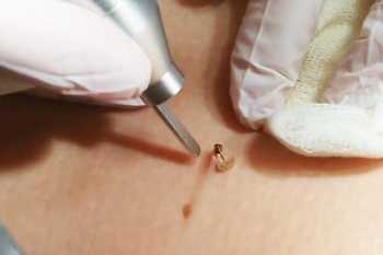 Лазерное удаление кожного рога