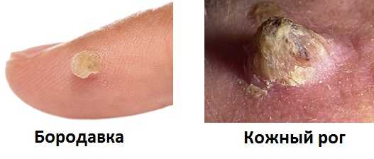 Сравнение бородавки и кожного рога