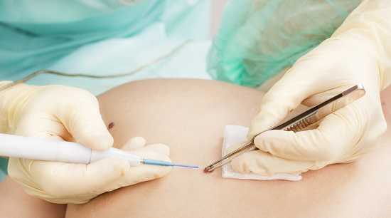 Лазерное удаление новообразований