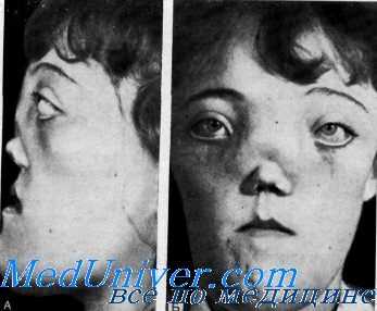 краниометафизарная дисплазия