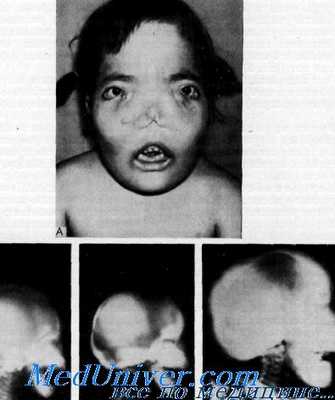 краниометафизарная дисплазия