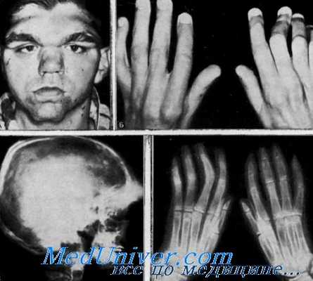 лобно-метафизарная дисплазия