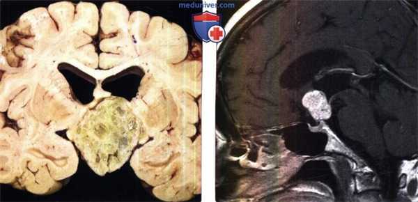 Краниофарингиома на МРТ и макропрепарате головного мозга