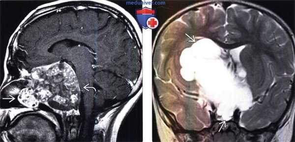 Краниофарингиома на МРТ головного мозга