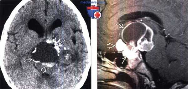 Краниофарингиома на КТ, МРТ головного мозга