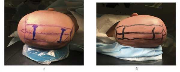 Плагиоцефалия