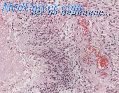 криптококкоз