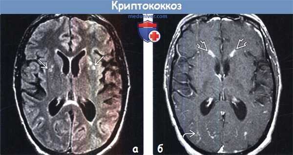 Криптококкоз головного мозга на МРТ