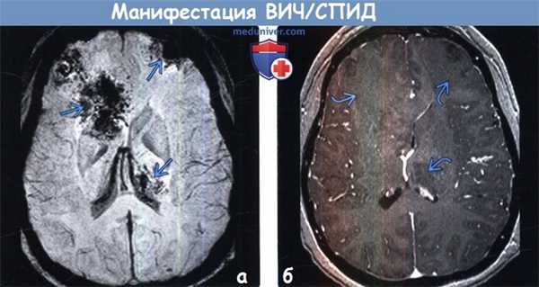 Манифестация ВИЧ/СПИД на МРТ головного мозга