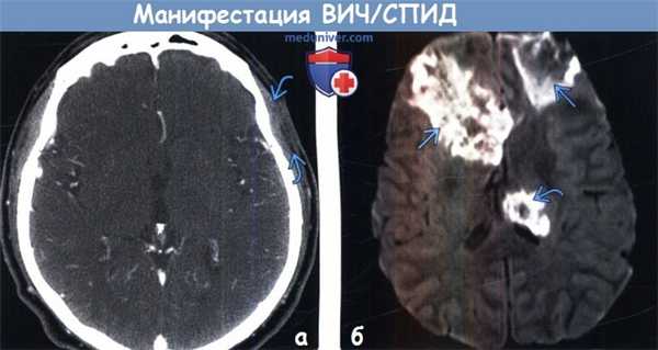 Манифестация ВИЧ/СПИД на КТ, МРТ головного мозга