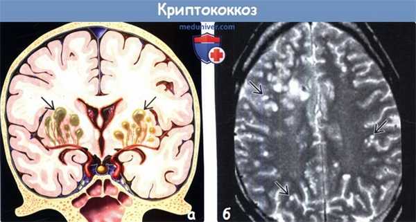 Криптококкоз головного мозга на МРТ