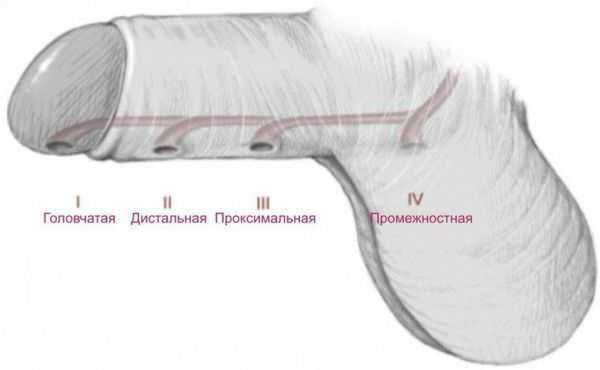 Виды гипоспадии по степени смещения наружного отверстия уретры