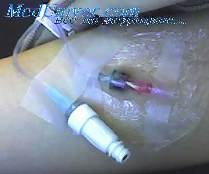 токсический шок