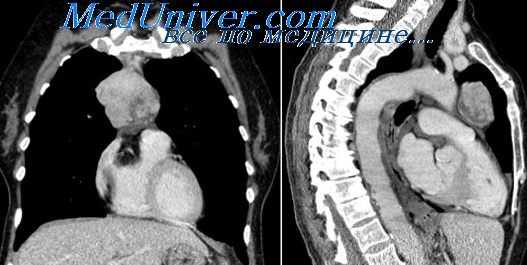 рентгенология тимом