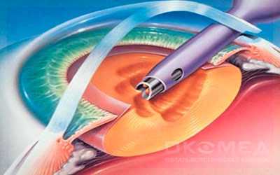 Какие осложнения могут быть после экстракции катаракты?