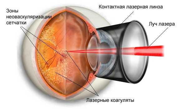 Гемофтальм глаза. Лечение. Лазеркоагуляция сетчатки