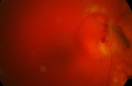 Тотальный гемофтальм