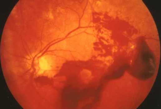 Частичный гемофтальм глаза