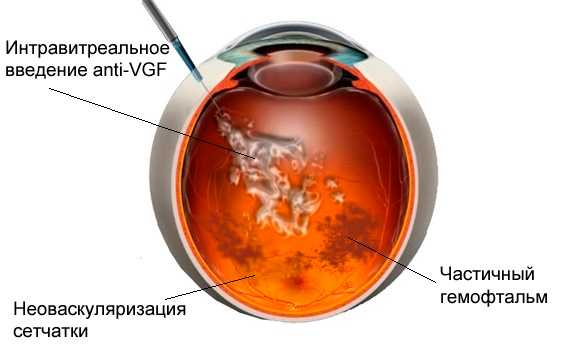 Гемофтальм глаза. Лечение антивазопролиферативными препаратами