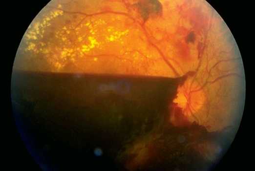 Субтотальный гемофтальм глаза