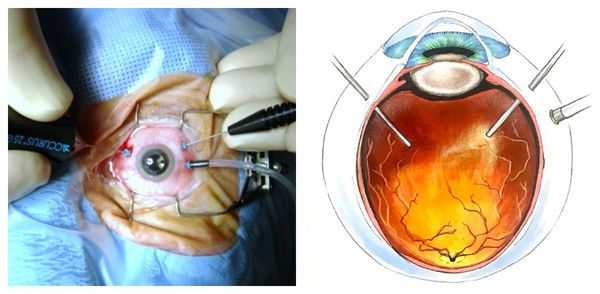 Удаление стекловидного тела