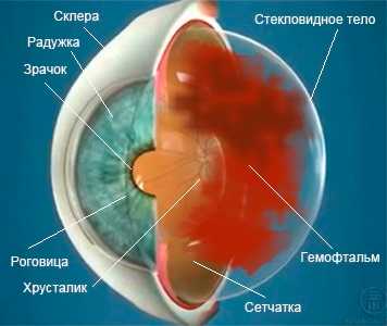 Кровь в стекловидном теле