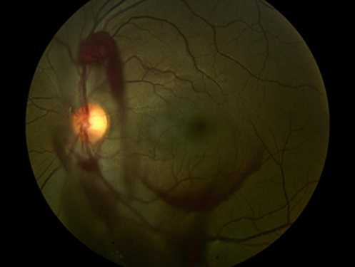 Гемофтальм глаза