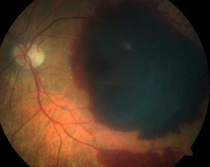 Гемофтальм глаза при дистрофии сетчатки