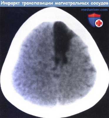 Инфаркт мозга после транспозиции магистральных сосудов