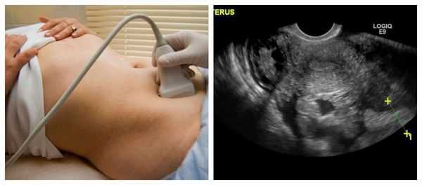 УЗ-признаки апоплексии яичника