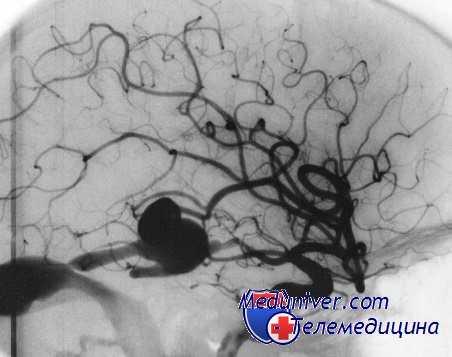 интраоперационный разрыв аневризмы
