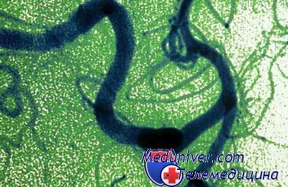 кровотечение при операции на аневризме головного мозга