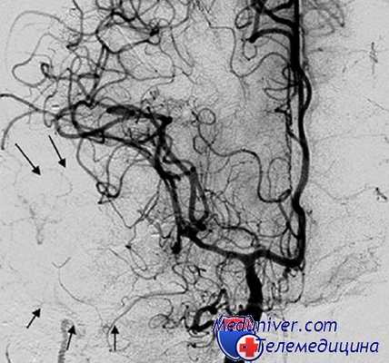 интраоперационный разрыв аневризмы