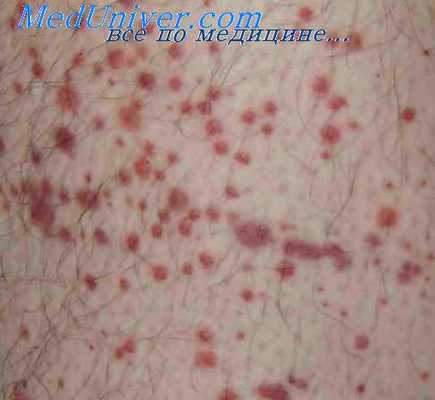 сыпь при тромбоцитопенической пурпуре