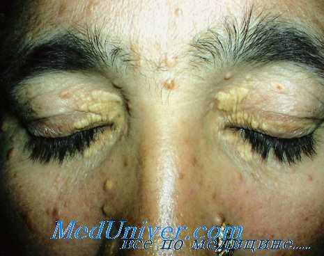 ксантоматоз