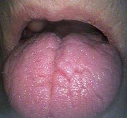 Ксеростомия фото