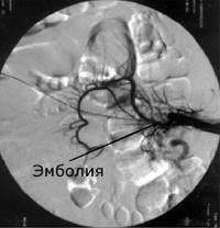 Тромбоз воротной вены