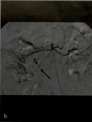 Снимки МРТ и КТ. Желудочно кишечное кровотечение